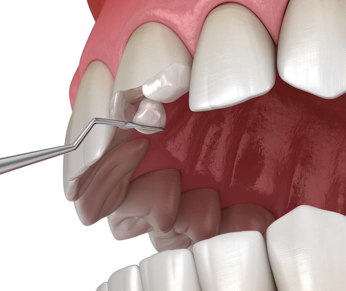 Dobudovanie zubu fotokompozitnou výplňou po odlomení časti zubu